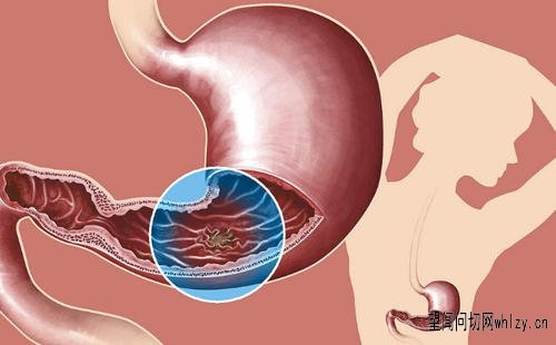 慢性胃炎伴增生轻度CAG伴肠上皮化生Hp++用什么中药调理效果好？