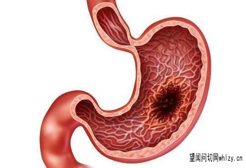 糜烂性胃炎，反酸吞酸10年余之典型病案