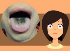 中医望诊之舌诊的方法：舌苔发黑就是得了癌症了吗？